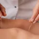 Acupuncture for Stress and Anxiety Relief: Your Essential Guide