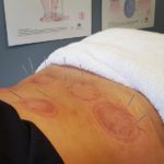 Sports Recovery Acupuncture: 6 Essential Benefits Explained