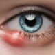 Eye Styes: Causes and Home Remedies You Should Know