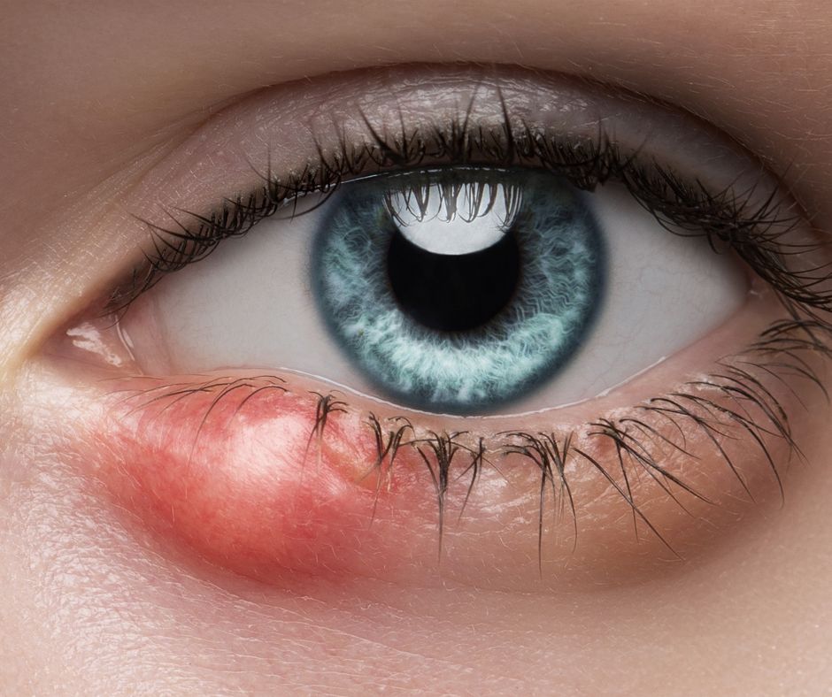 Eye Styes: Causes and Home Remedies You Should Know